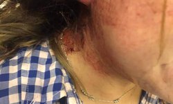 Buscan a potencial femenicida que atacó a su ex novia en Ciudad Valles