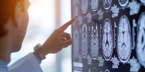 Descubren mecanismos clave en la propagación del Parkinson: qué significa para los tratamientos.