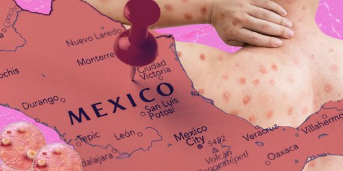 Alertan por caso de mpox en México; festival de Zipolite, posible punto de infección