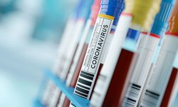 Coronavirus: la nueva prueba de anticuerpos que es "crucial" para hacer frente a pandemia del covid-19