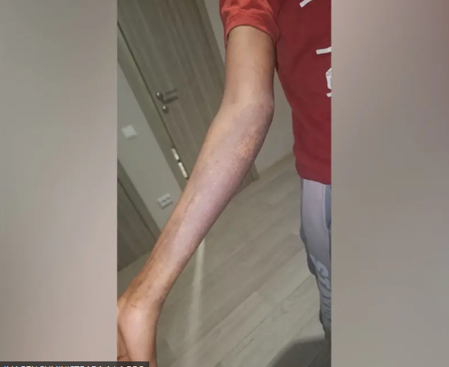 quemadura por sustancias quimicas-mi rioverde.png