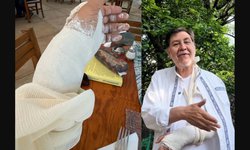 Fernández Noroña se fractura la muñeca tras sufrir una caída durante caminata en Tepoztlán.