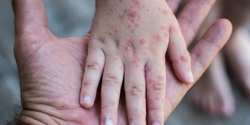 No hay casos de sarampión en San Luis Potosí: Secretaría de Salud