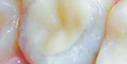 Tratamiento Restaurador Atraumático nueva alternativa bucodental: SSA
