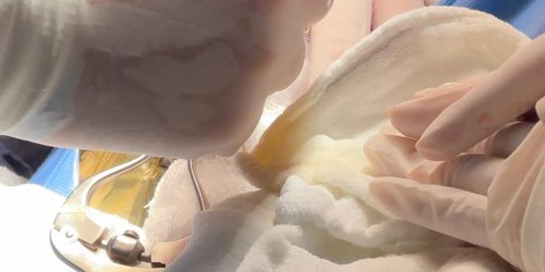 Gobierno estatal brinda más apoyo a niñas y niños con cirugías gratuitas