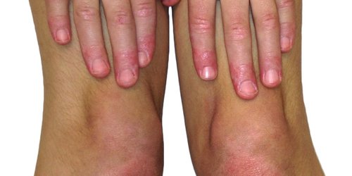 Hoy es el Día Mundial de las Enfermedades Reumáticas en niños, niñas y jóvenes