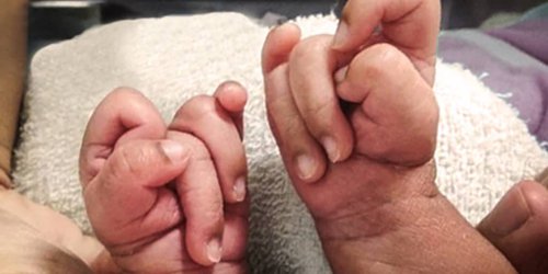 Día Internacional del síndrome de Edwards: Concienciación y Solidaridad